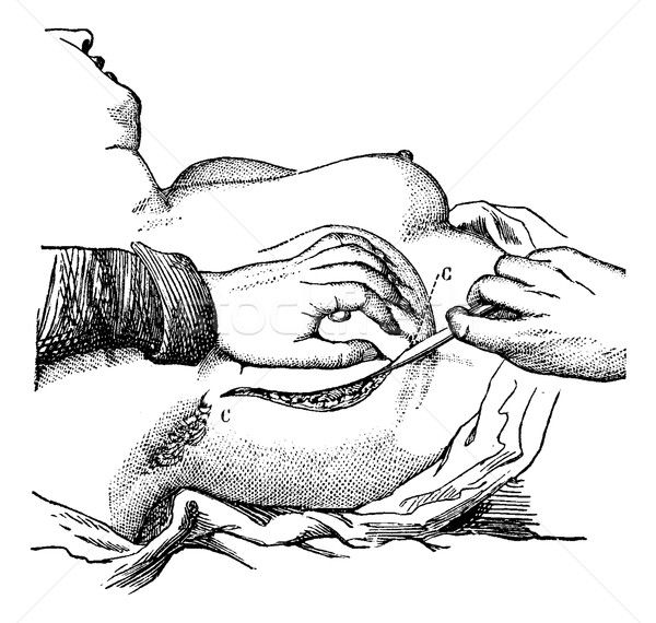 Removal of the breast (the first time), vintage engraving. Stock photo © Morphart