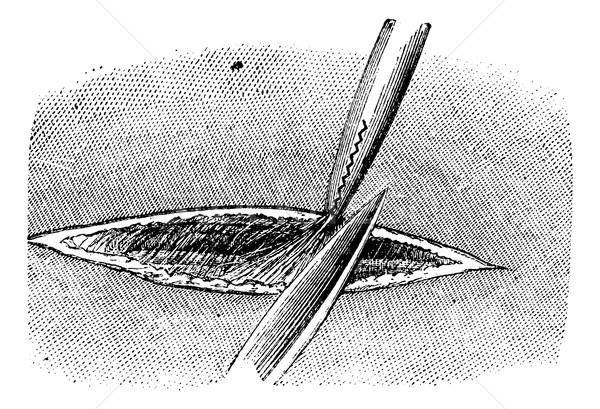 Stock photo: Dissection of the skin to discover the artery, vintage engraving