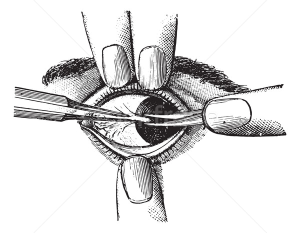 Excision of pterygium, vintage engraving.  Stock photo © Morphart