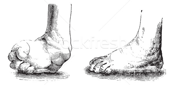 Clubfoot equine before and after the operation, vintage engravin Stock photo © Morphart