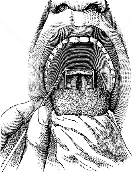 Laryngoscopy, vintage engraving Stock photo © Morphart