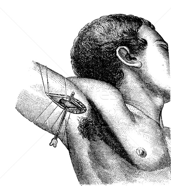 Axillary artery ligation in the armpit, vintage engraving. Stock photo © Morphart
