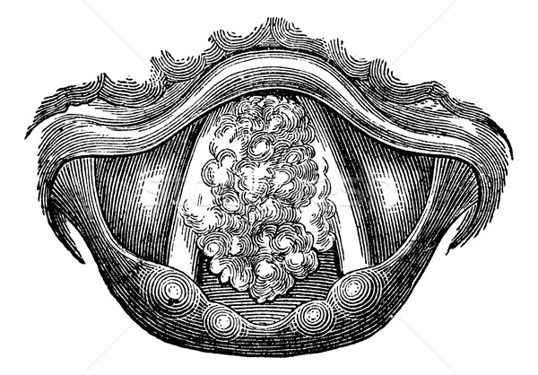Myxoma of the Larynx, vintage engraving Stock photo © Morphart