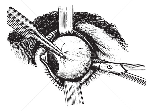 Stock photo: Extirpation of the eye, vintage engraving.