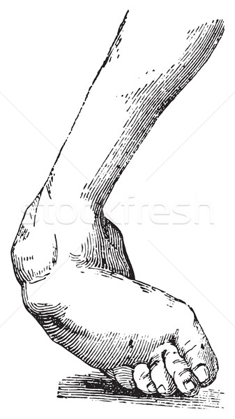 Clubfoot associated with equine varus, vintage engraving. Stock photo © Morphart