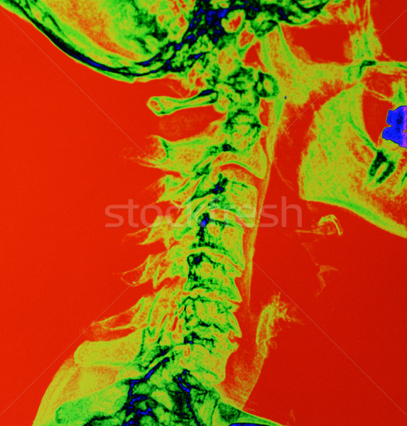 Color enhanced X Ray of a spine Stock photo © MSPhotographic