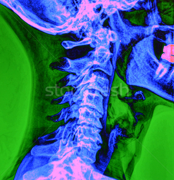 脊 X射線 顏色 數字 人 脊柱 商業照片 © MSPhotographic