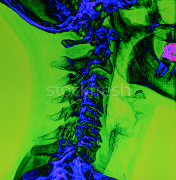 Back and spine x-ray Stock photo © MSPhotographic