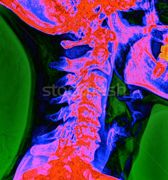 Spine X-Ray in Color Stock photo © MSPhotographic