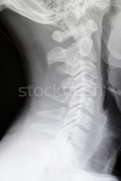 Menselijke wervelkolom x ray tonen medische wetenschap Stockfoto © MSPhotographic