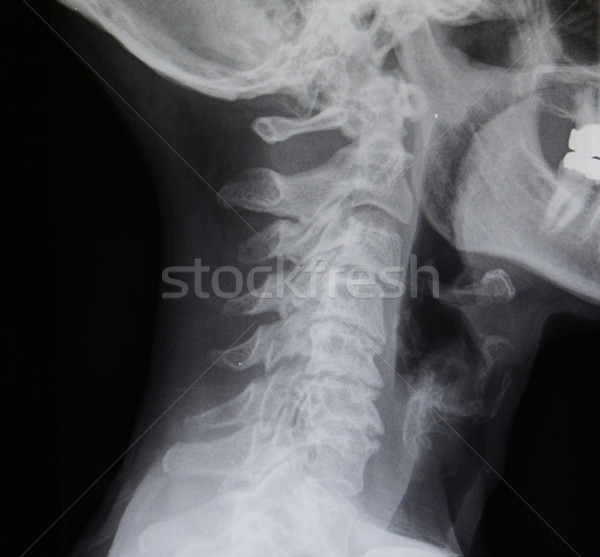 Uman sira spinarii Xray negru alb digital medical Imagine de stoc © MSPhotographic