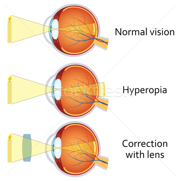 Hyperopia corrected by a plus lens. Stock photo © Neokryuger