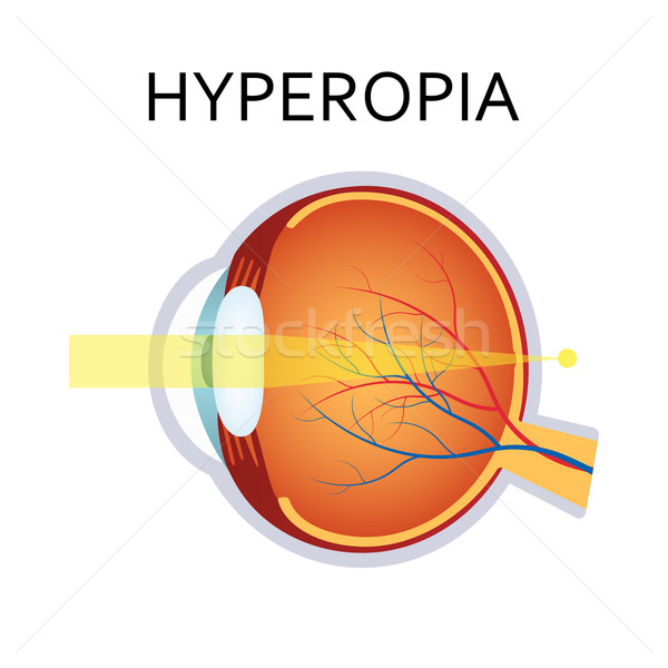 Hyperopia eyesight disorder. Stock photo © Neokryuger