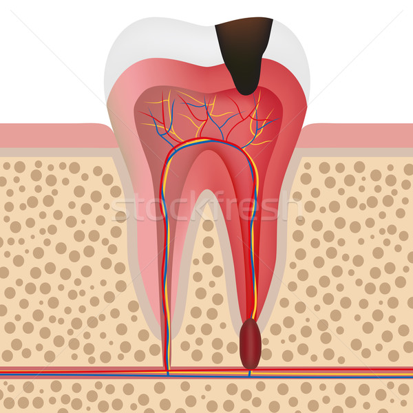 Ilustracja zakażony zębów medycznych stomatologicznych Zdjęcia stock © Neokryuger