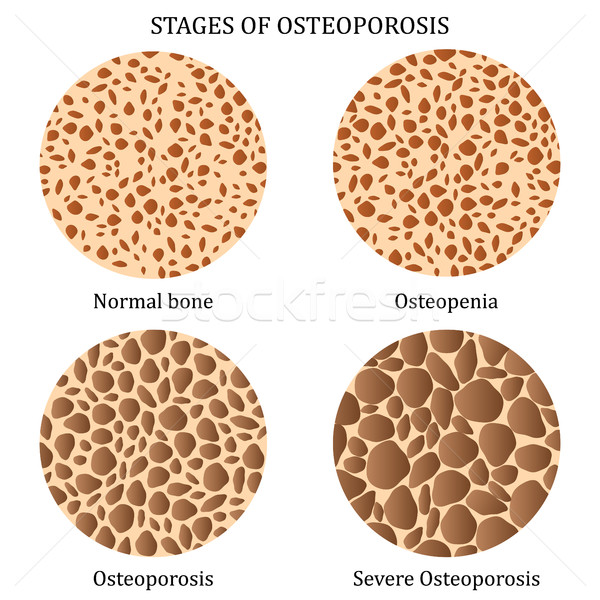 Osteoporoza medycznych ilustracja zdrowych kości kości Zdjęcia stock © Neokryuger