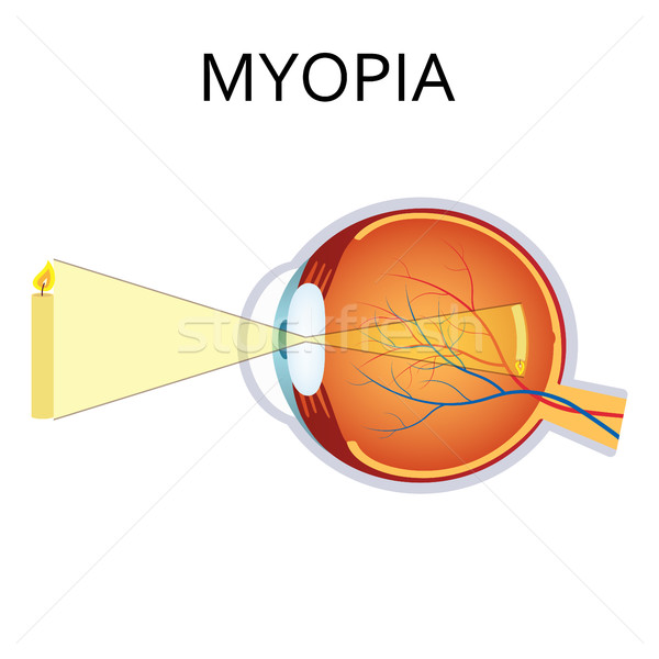 Illustration of myopia. Stock photo © Neokryuger