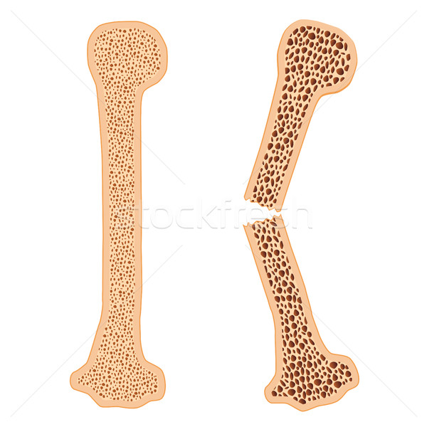 Zdjęcia stock: Zdrowych · kości · podziale · osteoporoza · biały · ból