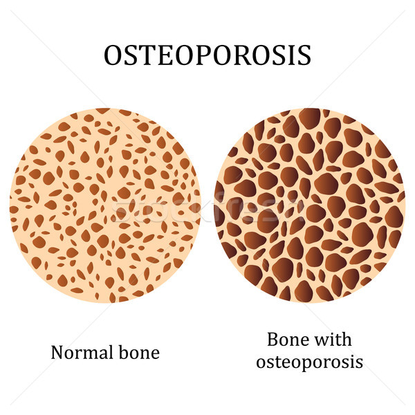 Stock foto: Gesunden · Knochen · Osteoporose · medizinischen · Illustration · menschlichen