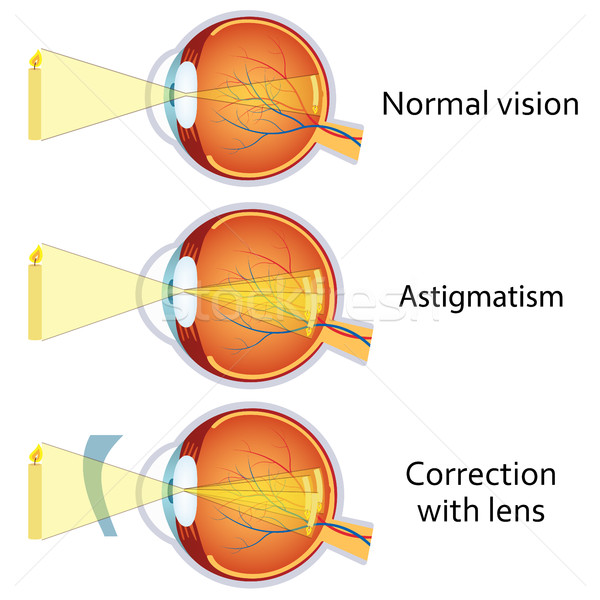 Astigmatism corrected by a cylindrical lens. Stock photo © Neokryuger