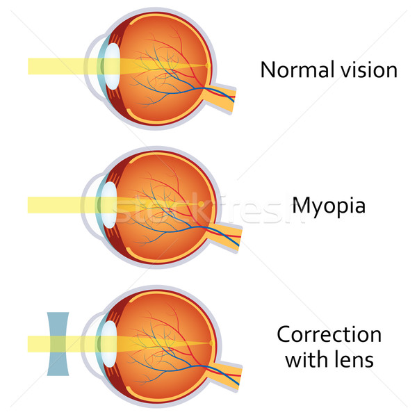 Myopia and myopia corrected by a minus lens. Stock photo © Neokryuger