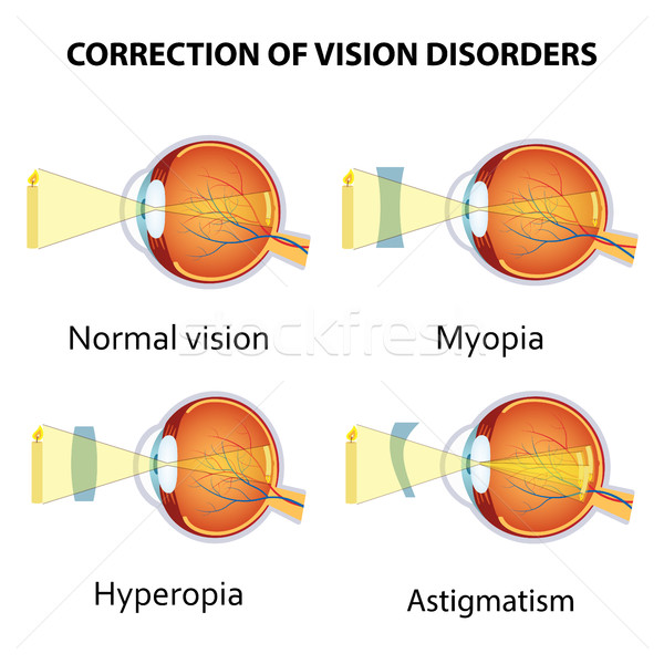 Correction of eye vision disorders by lens. Stock photo © Neokryuger