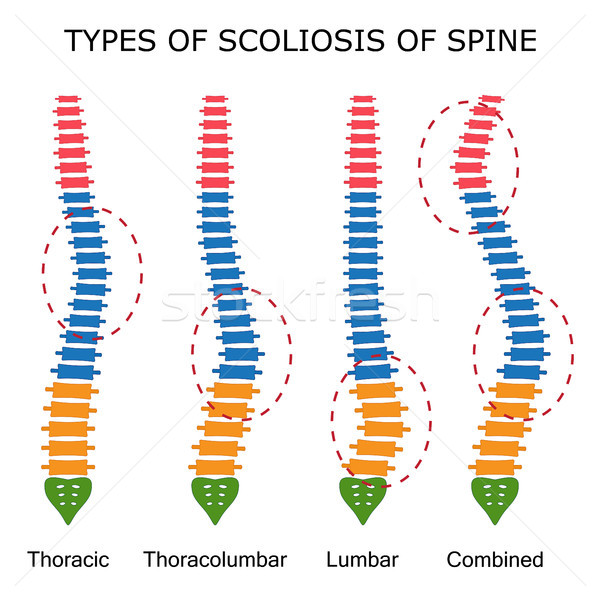 Stock photo: Types of scoliosis of spine.