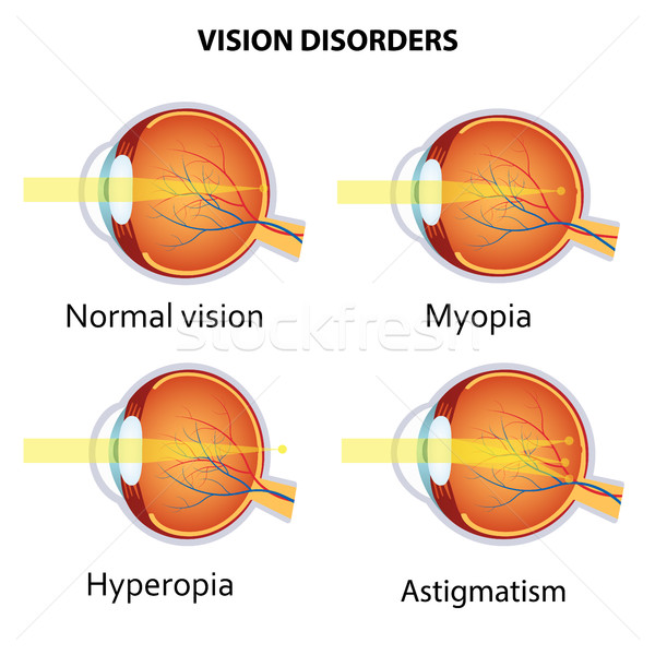Vision Auge lange verschwommen Krankheit optische Stock foto © Neokryuger