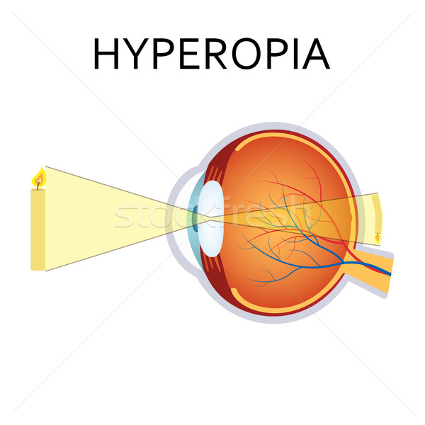Hyperopia eyesight disorder. Stock photo © Neokryuger