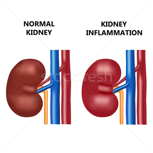 Healthy kidney and kidney infection. Stock photo © Neokryuger