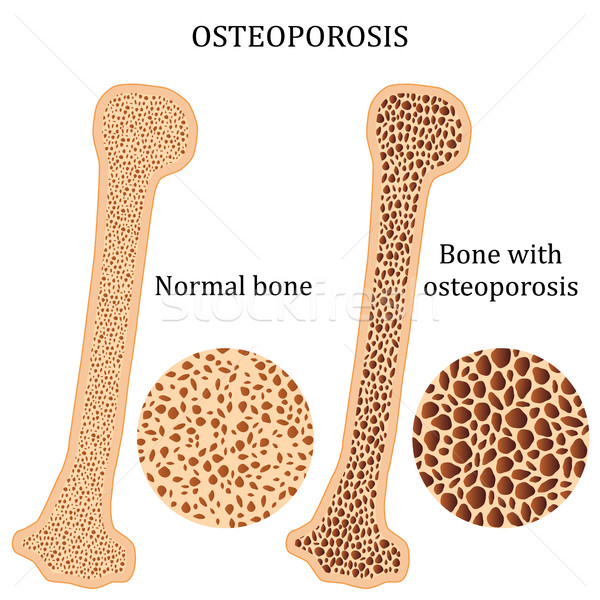 Healthy bone and osteoporosis bone. Stock photo © Neokryuger