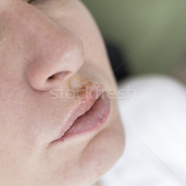 Herpes on the lips of the young woman Stock photo © nessokv