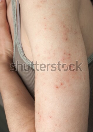 Alergic piele textură pacient mână corp Imagine de stoc © nessokv