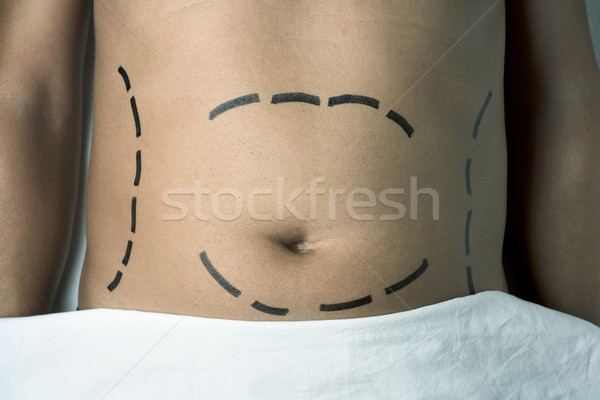 Mann plastische Chirurgie Fettabsaugung erschossen Abdomen jungen Stock foto © nito