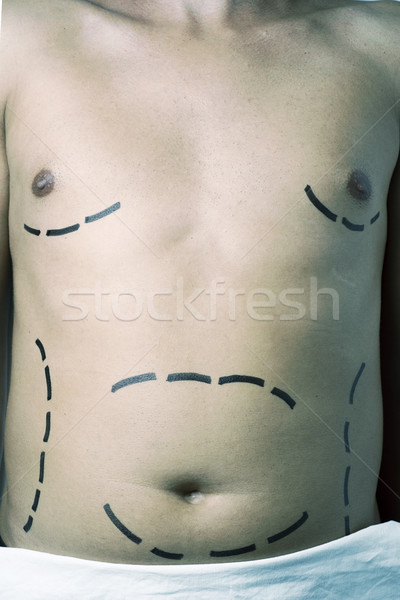 Człowiek chirurgia plastyczna liposukcja widoku młodych Zdjęcia stock © nito