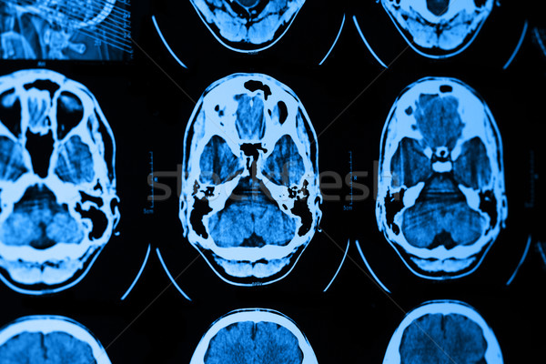 Mri schedel foto medische film technologie Stockfoto © Nneirda