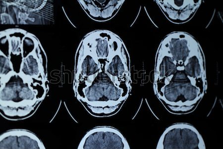 CT and MRI of the skull Stock photo © Nneirda