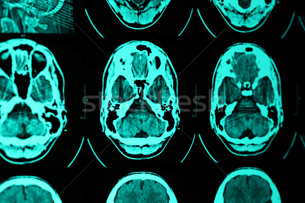 Rmn craniu fotografie medical film tehnologie Imagine de stoc © Nneirda