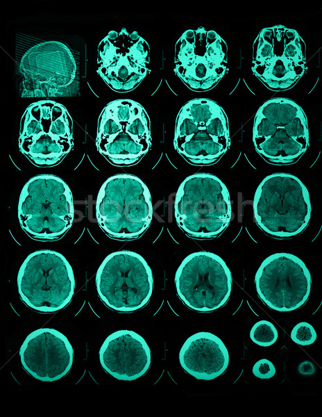 CT and MRI of the skull Stock photo © Nneirda