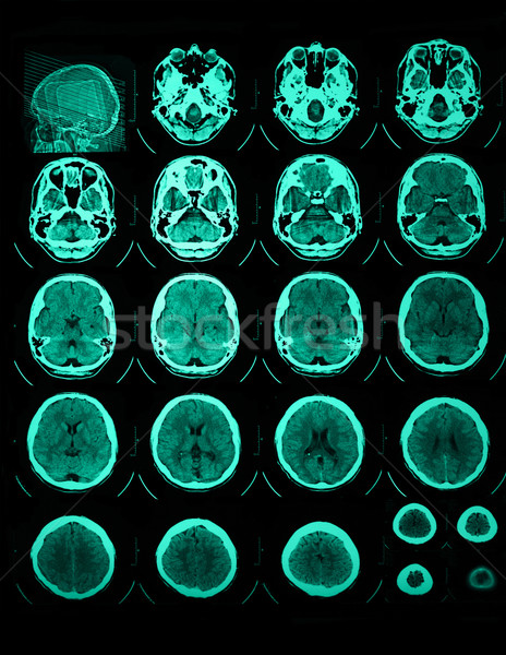 ストックフォト: Mri · 頭蓋骨 · 写真 · 映画 · 技術 · 健康