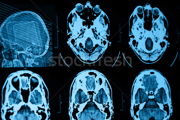 Mri schedel foto medische film technologie Stockfoto © Nneirda