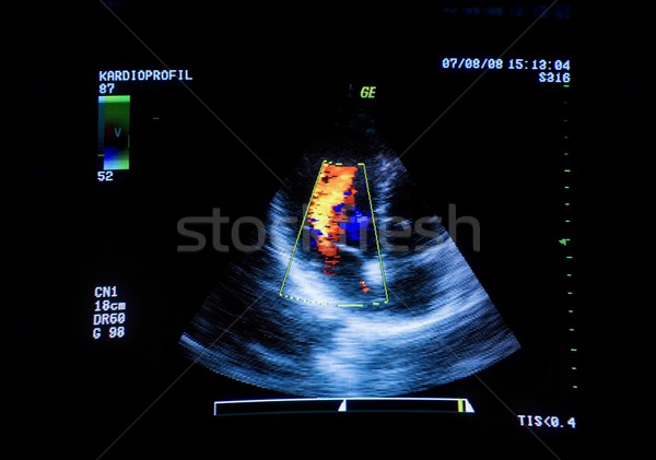 心臟 超聲 圖像 電腦屏幕 醫生 技術 商業照片 © nyul