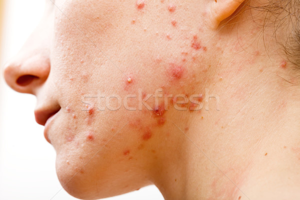 Akne Haut Gesicht jungen Kopf Teenager Stock foto © Obencem