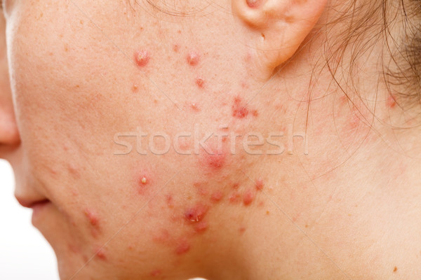 Acne huid gezicht jonge hoofd tiener Stockfoto © Obencem