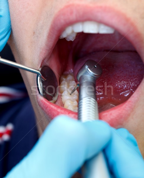 Dentales perforación dentista perforación diente turbina Foto stock © ocskaymark