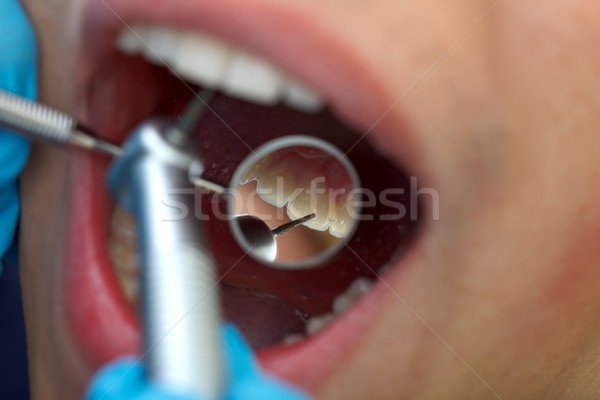 Dentaires forage dentiste forage dents turbine [[stock_photo]] © ocskaymark