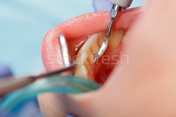 Dental calculus removing Stock photo © ocskaymark