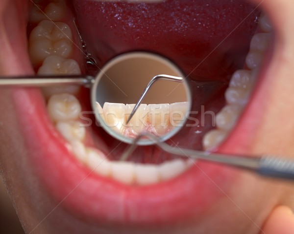 Extensive dental examination Stock photo © ocskaymark