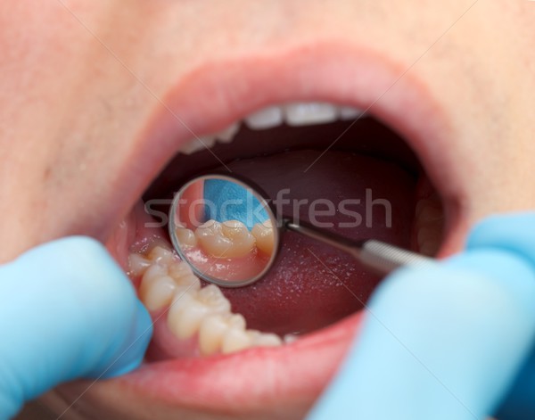 Extensive dental examination Stock photo © ocskaymark