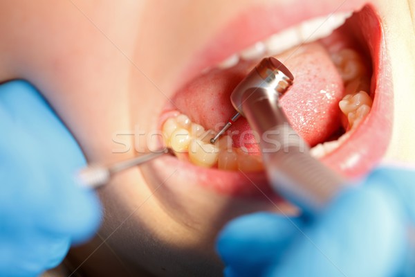 Stok fotoğraf: Diş · delme · dişçi · el · doktor · tıp