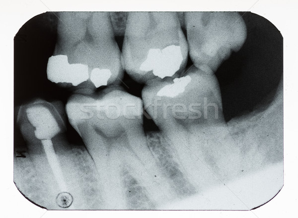 dental xray Stock photo © pancaketom